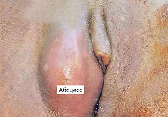 Абсцесс