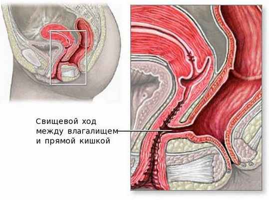 Влагалищно-прямокишечный свищ