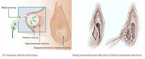 Установка Word-катетера и марсупиализация