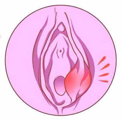 Бартолинит - современное лечение в Клиническом госпитале на Яузе