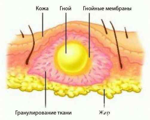 абсцесс схематично