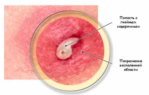 Асцесс под микроскопом