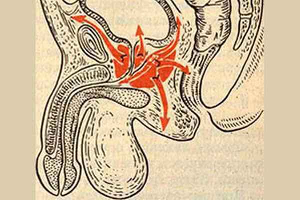 Абсцесс предстательной железы схематично