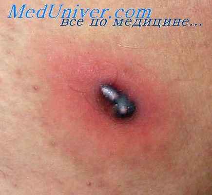 абсцесс в хирургии