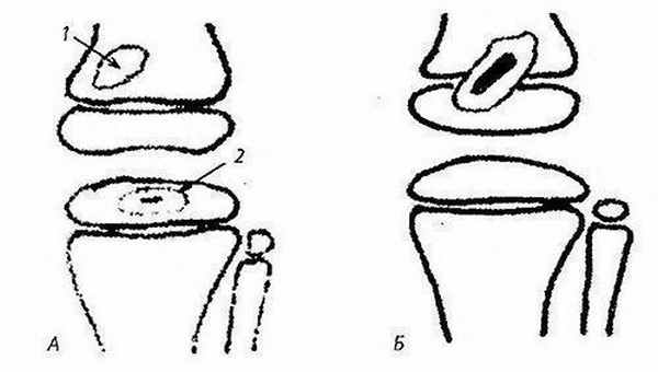Схема локализации туберкулезного процесса при поражении коленного сустава