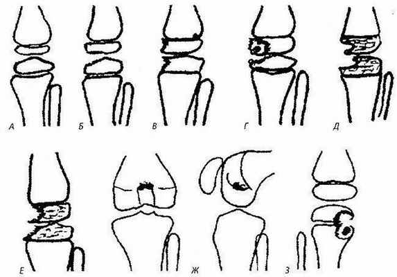 Этапы развития туберкулезного процесса сустава (схема)