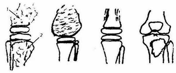 Варианты злокачественных опухолей коленного сустава 
