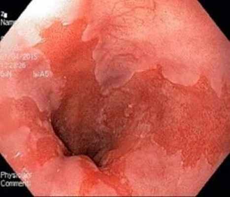 Пищевод Барретта эндоскопия