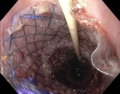 Стентирование