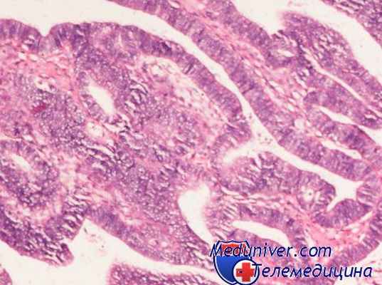 аденокарцинома пищевода