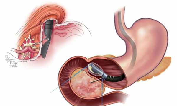 Эндоскопическое УЗИ