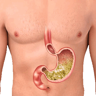 Рак желудка