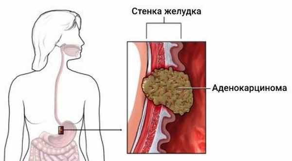 Аденокарцинома желудка