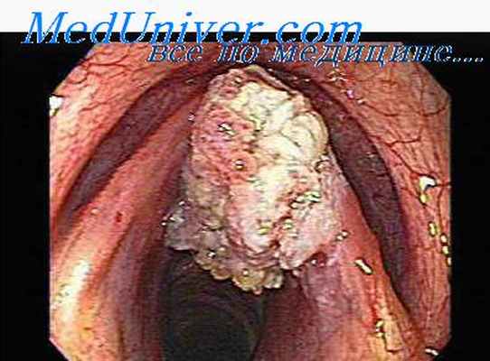 аденома гортани