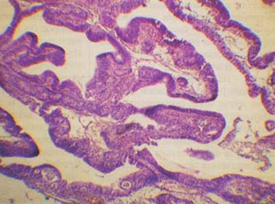 Тубулярная аденома желудка (×200) (Звенигородская А.П.)