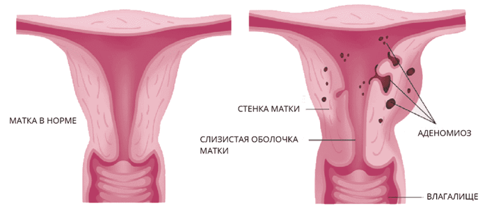 аденомиоз.png