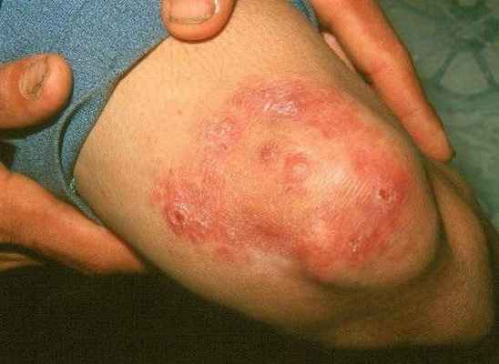 лепра или проказа 