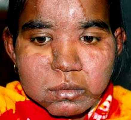 этиология и патогенез проказы лепры 