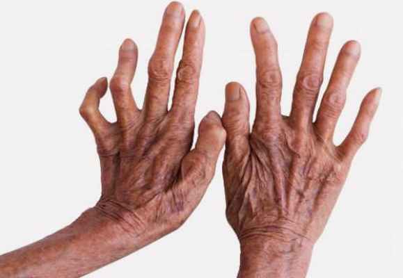 лепра что это такое этиология и патогенез лепры