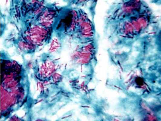 этиология эпидемиология патогенез 