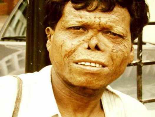  Проказа этиология патогенез 