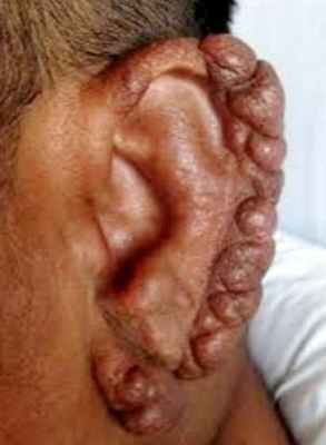 патогенез лепры инфекции 