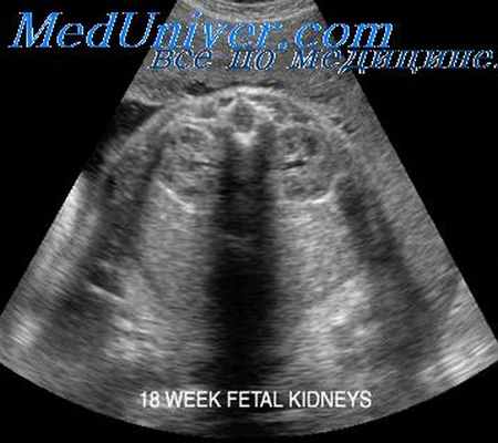 агенезия почек плода