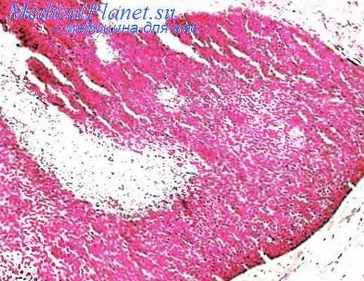 Опухоль волосяного матрикса