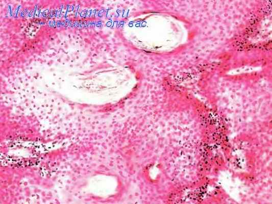 Трихоэпителиома