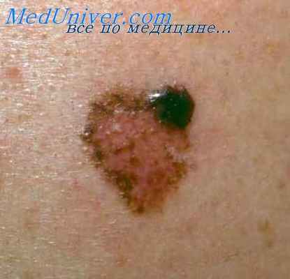 трихолеммома