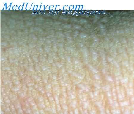 акрокератоз Базекса