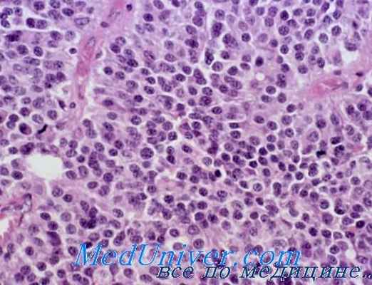 аденома гипофиза