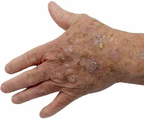 солнечный кератоз фото