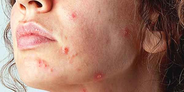 актинический кератоз фото