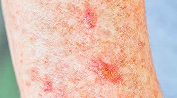 Актинический кератоз