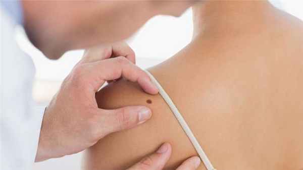 предраковые заболевания кожи лица