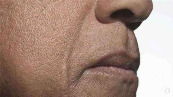 предраковые заболевания кожи и мягких тканей