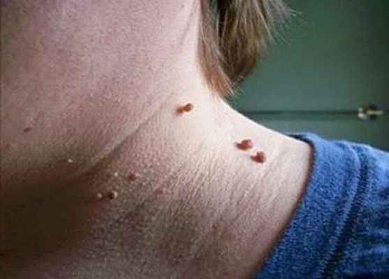 Новообразования на коже: виды, причины развития, методы диагностики, терапия, профилактика