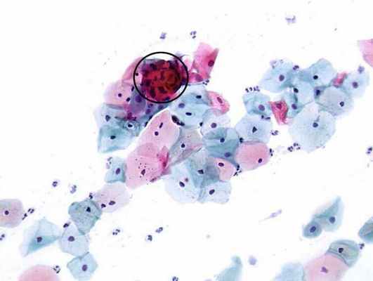 Паракератоз - это ороговение слизистого слоя шейки матки: возможные причины, симптомы, методы диагностики и терапия