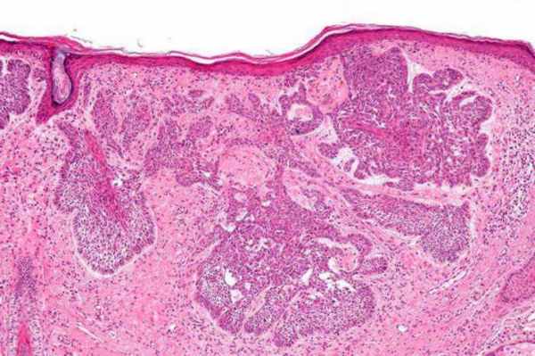 Базально-клеточный рак кожи: симптомы, методы диагностики, терапия