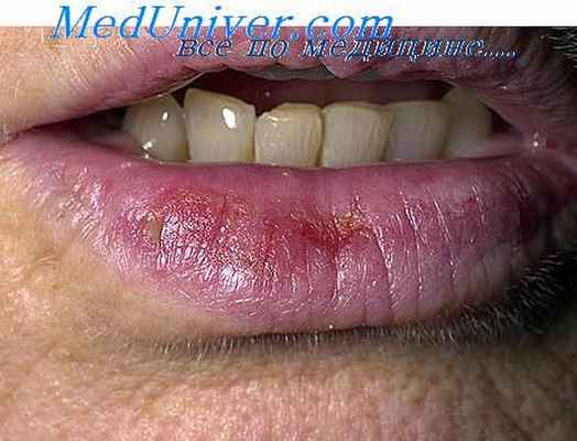 актинический хейлит