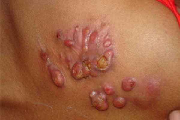 Язвенный актиномикоз