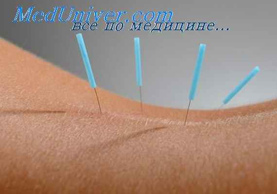 акупунктура при влечении к алкоголю