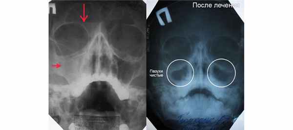 КТ и рентген гайморовых пазух
