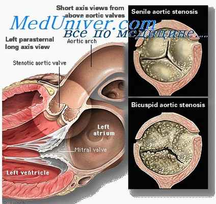 митральный стеноз