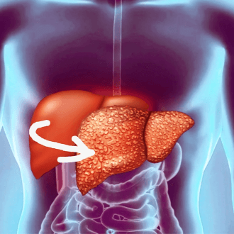 Алкогольные поражения печени