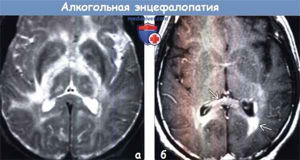 Алкогольная энцефалопатия на МРТ