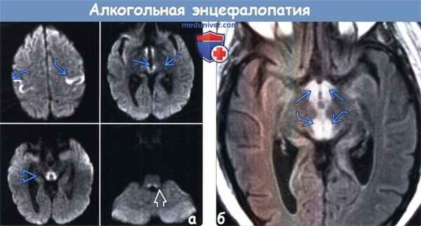 Алкогольная энцефалопатия на МРТ