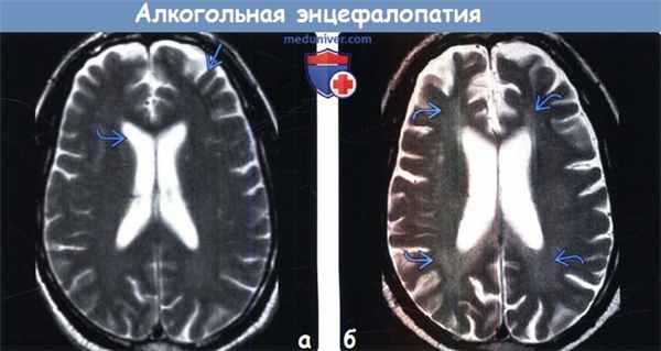 Алкогольная энцефалопатия на МРТ