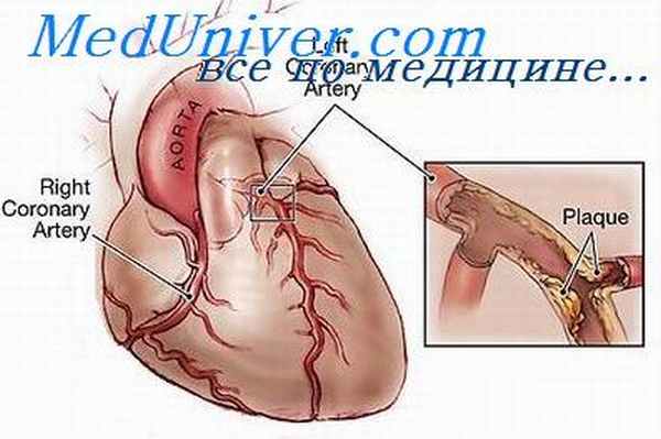 коронарный кровоток при алкоголизме
